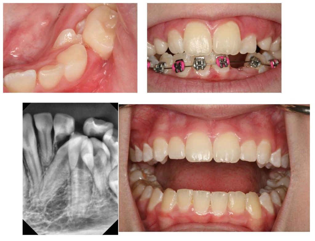 Teeth being treated with orthodontics