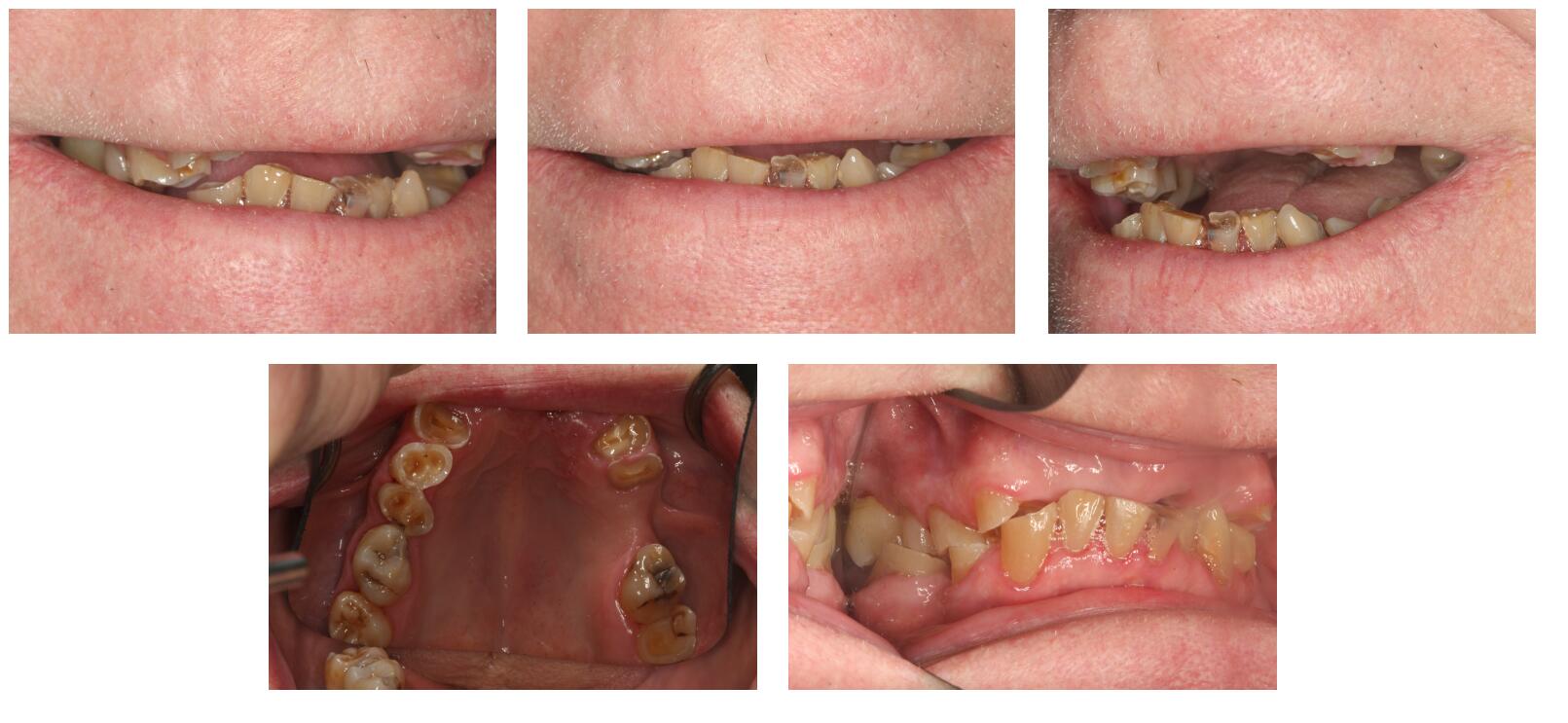 Teeth Grinding in Kittanning Bruxism Voller Dentistry
