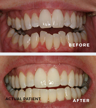 ClearCorrect Before and After