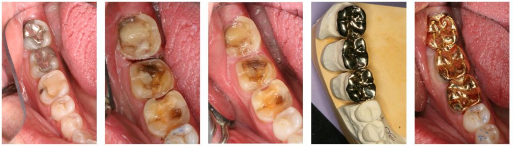 Crowns and fillings