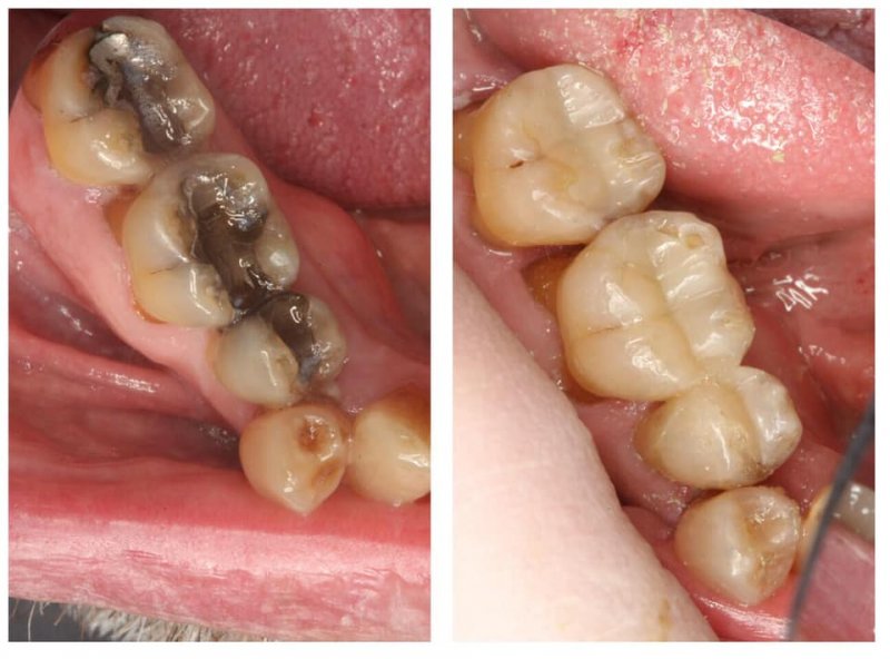 Metal and tooth-colored fillings