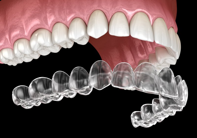 Clear Aligner