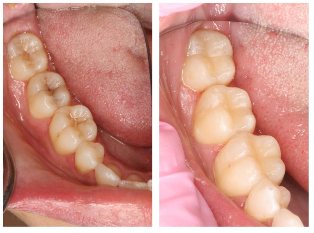 Close-up of teeth before and after tooth decay is treated