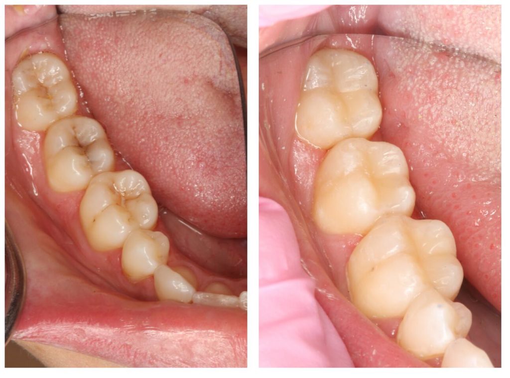 Which filling should I choose for my tooth? - Dentist in Sydney