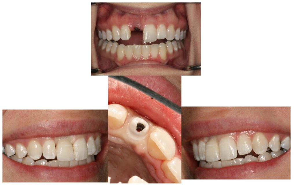Before and after images of dental implant placement