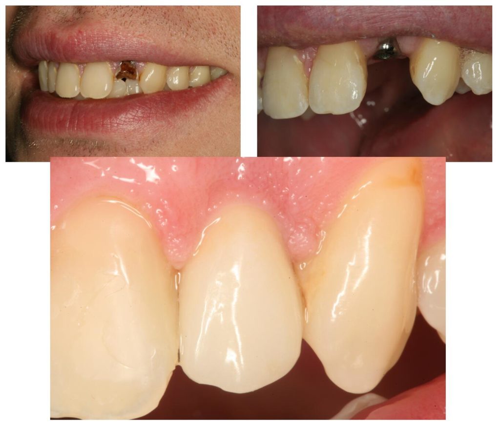 Missing tooth, dental implant, and lifelike dental crown