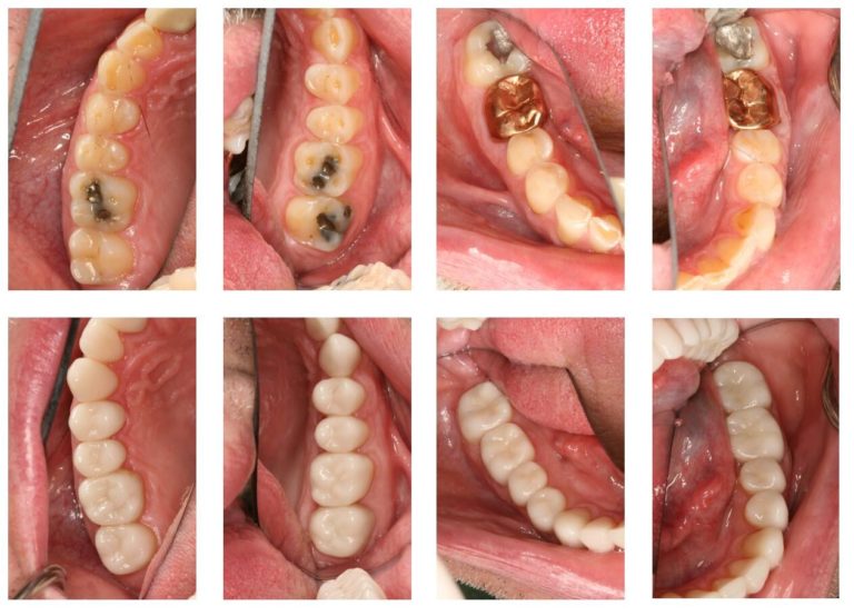 Dental Crown in Kittanning Replacing Dental Crowns Voller Dentistry