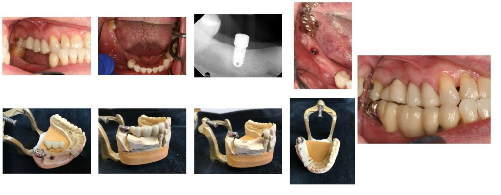 Series of images showing row of teeth replaced by implants