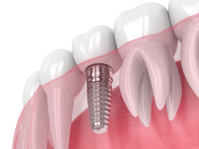 Dental implant in lower arch with natural teeth