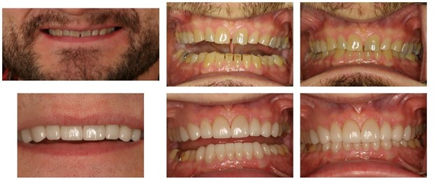 Before and after photos of a patient's smile