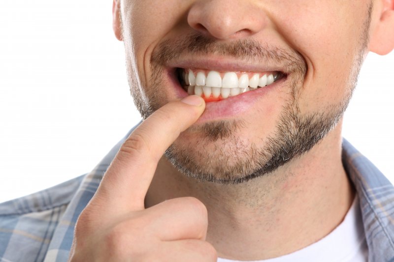 Man holding up lip showing signs of gum disease
