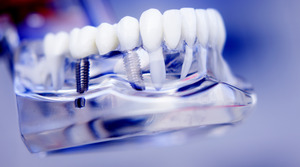 Dental implant in a plastic model next to other teeth