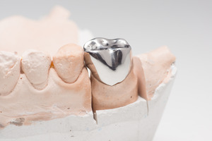 Metal crown on an impression of the lower dental arch