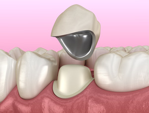 Porcelain fused to metal crown being placed on tooth