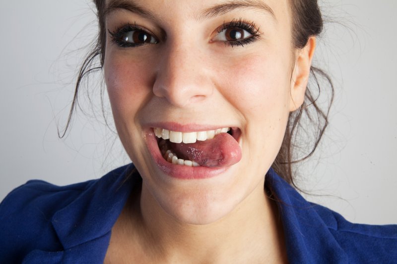 Patient sticking out their tongue after a frenectomy