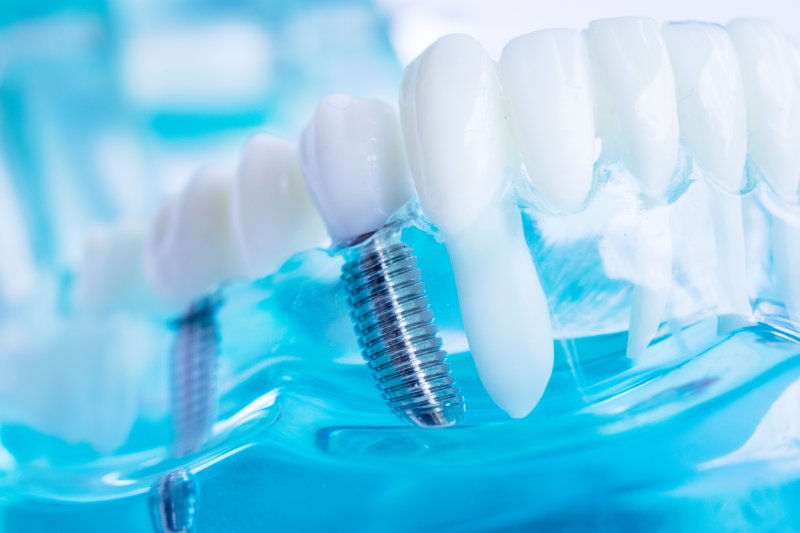 a model of a dental implant in a plastic jawbone