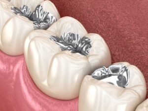 Digital rendering of metal tooth fillings.